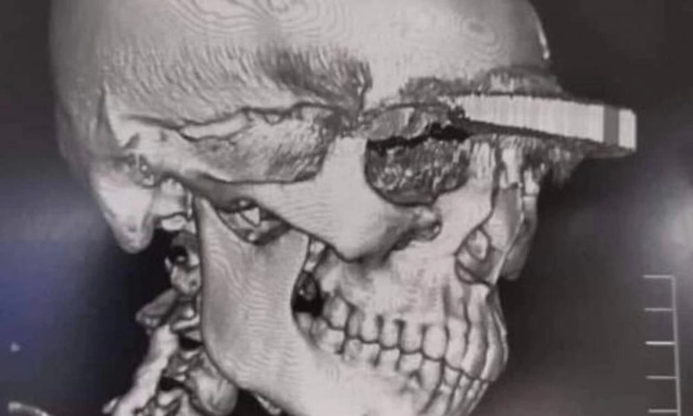 Εικόνες σοκ! Άνοιξε το κεφάλι της νυν του πρώην της με μπαλτά - Επέζησε από θαύμα